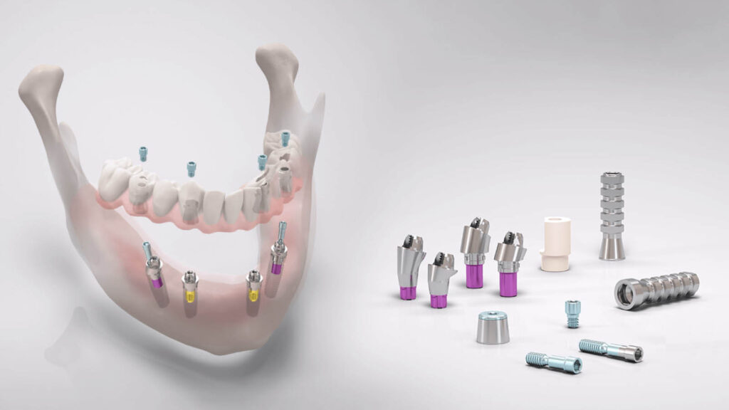 zahn-implantate-zahnfleisch-inlay_01