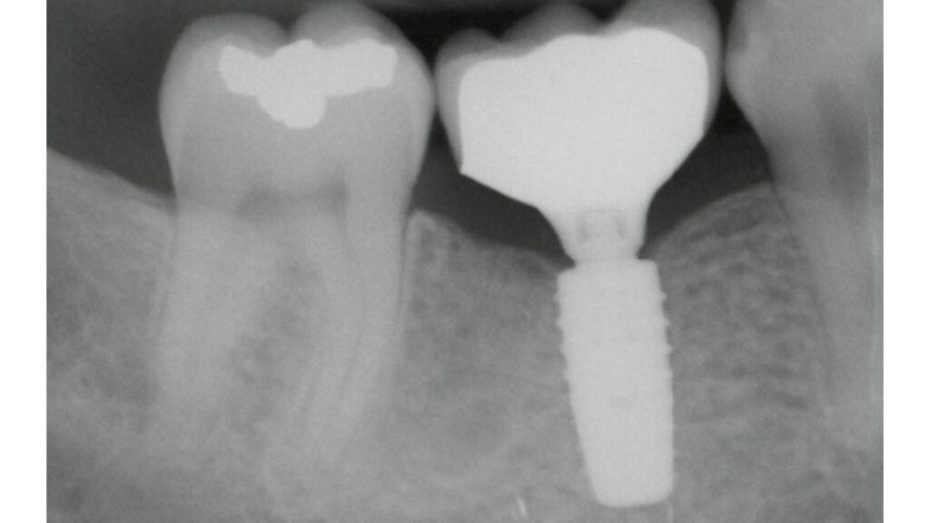zahn-implantate-zahnfleisch-inlay_02