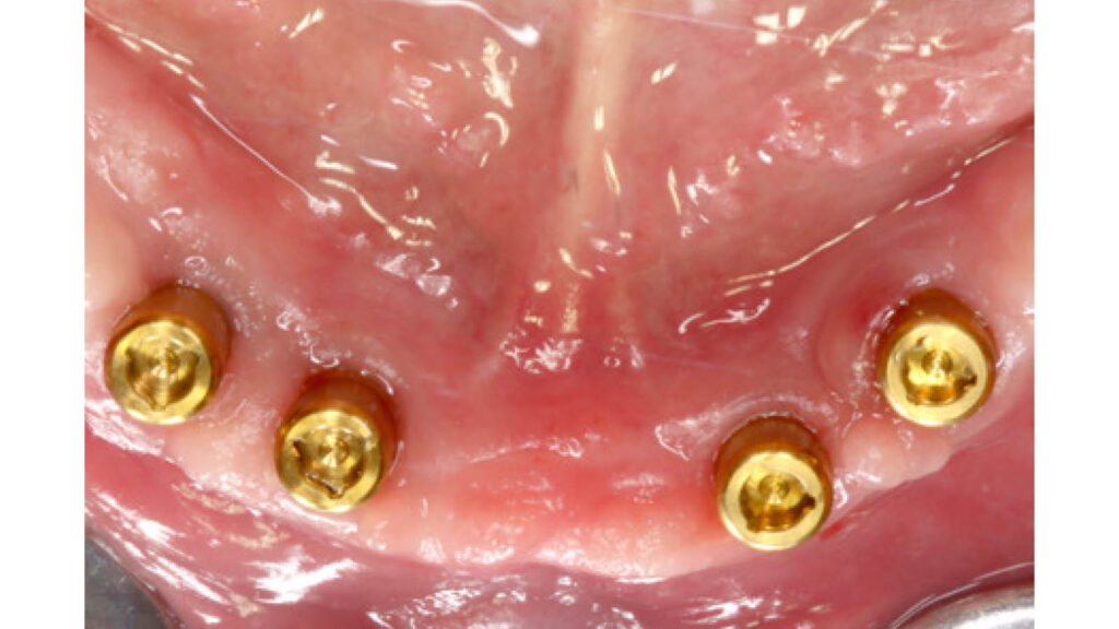 zahn-implantate-zahnfleisch-inlay_03