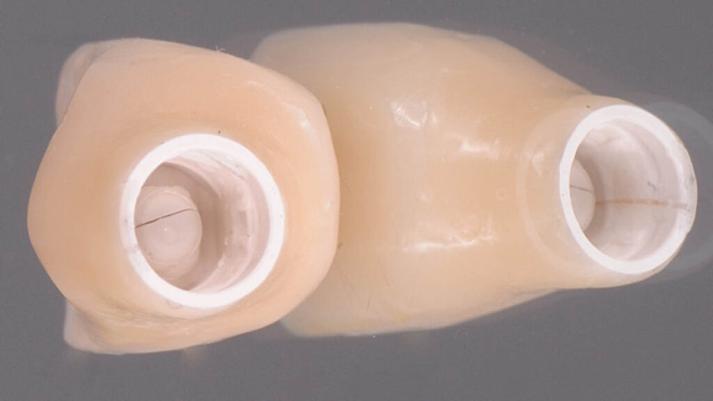 zahn-implantate-zahnfleisch-inlay_04